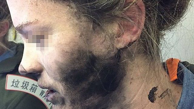 Após explosão de fones de ouvido, mulher sofre queimaduras no rosto