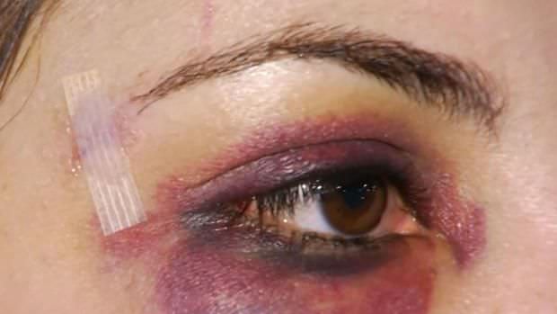 Casos de violência física atendidos em unidades de saúde poderão ser obrigatoriamente notificados