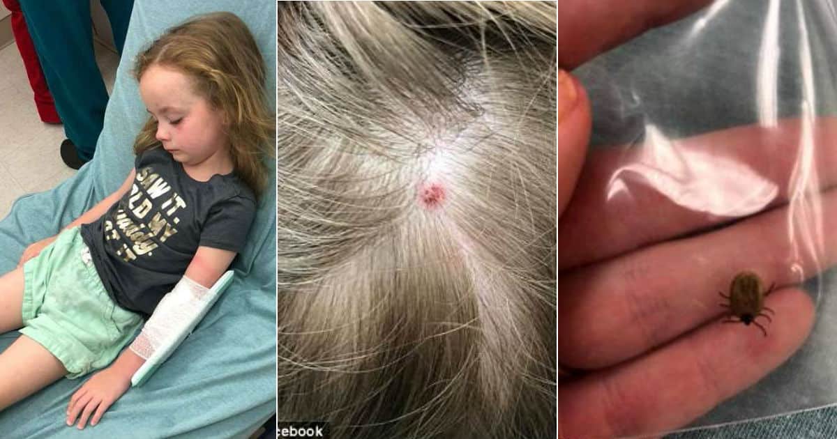 Menina de 5 anos fica paralisada após mordida de carrapato