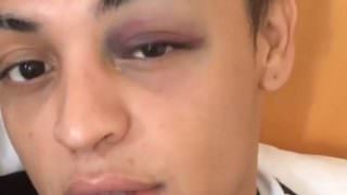 VÍDEO: Pabllo Vittar adia gravação de clipe após acertar joelhada no próprio olho