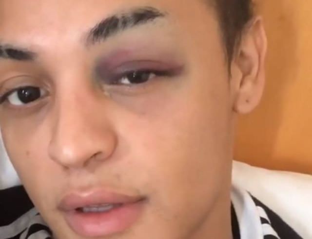 VÍDEO: Pabllo Vittar adia gravação de clipe após acertar joelhada no próprio olho