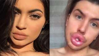 Fã gasta R$69 mil e tem complicações para ter lábios iguais aos de Kylie Jenner