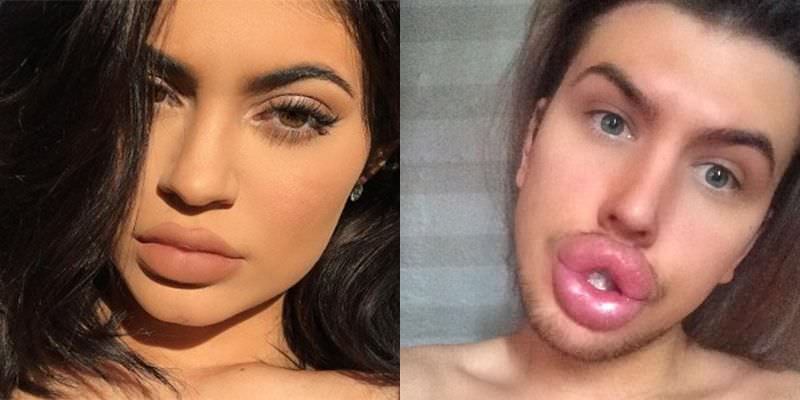 Fã gasta R$69 mil e tem complicações para ter lábios iguais aos de Kylie Jenner