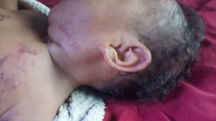 Pai é suspeito de agredir com mordidas filho de 7 meses no AM