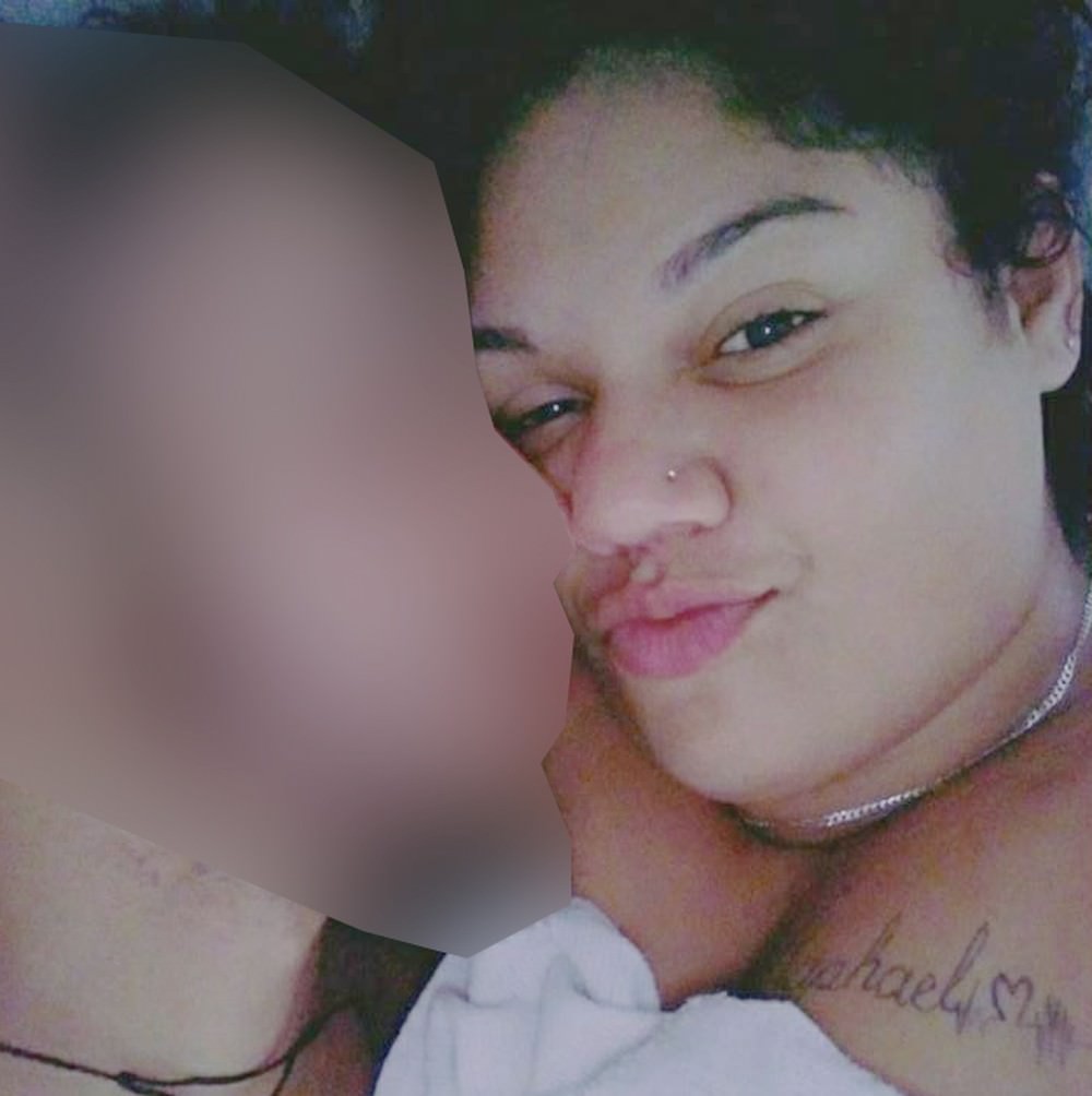 Jovem tem 80% do corpo queimado por causa de tatuagem; namorado é suspeito