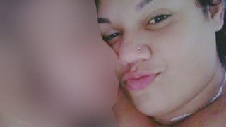 Jovem tem 80% do corpo queimado por causa de tatuagem; namorado é suspeito