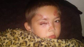 Menino de 6 anos defende amigo vítima de bullying e é atacado por 7 crianças