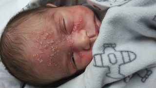 Bebê de 17 dias contrai herpes após beijo de visita e mãe faz alerta