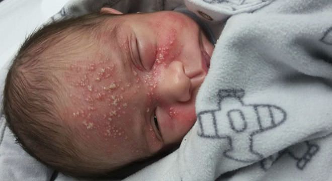 Bebê de 17 dias contrai herpes após beijo de visita e mãe faz alerta