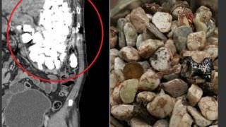 Médicos retiram 2 kg de pedras e bugigangas do estômago de coreano