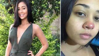 Jovem de 20 anos fica paraplégica após colocar piercing no nariz
