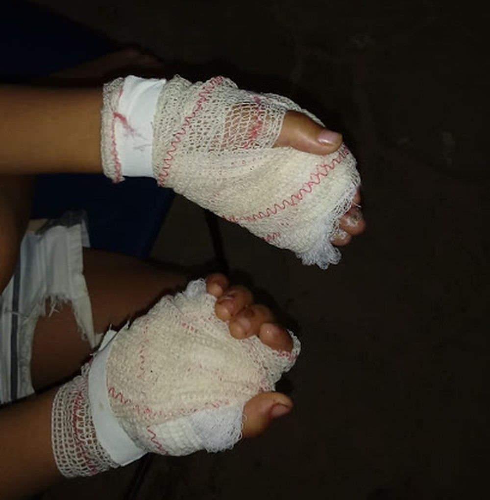 Mãe é presa após queimar as mãos do filho de 4 anos como castigo