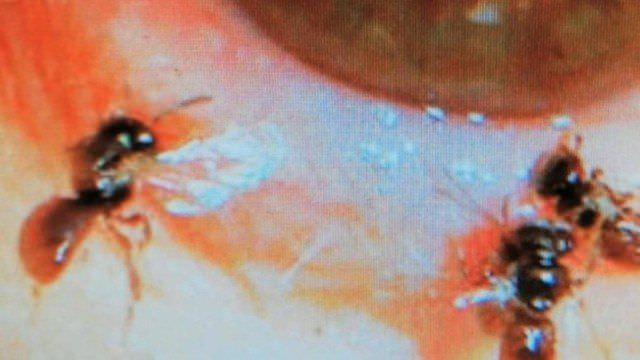 Mulher vai parar no hospital com dor nos olhos e descobre abelhas vivas