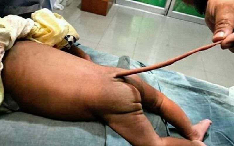 Bebê nasce com 'rabo' de 13 centímetros e o caso intriga especialistas