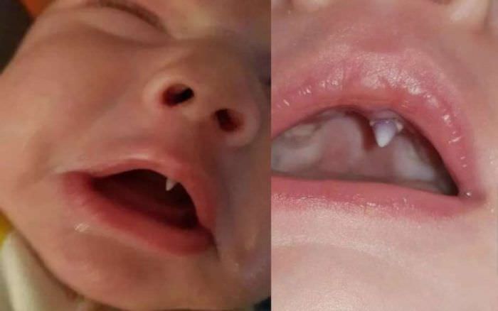Criança nasce com dente de vampiro e surpreende médicos e família