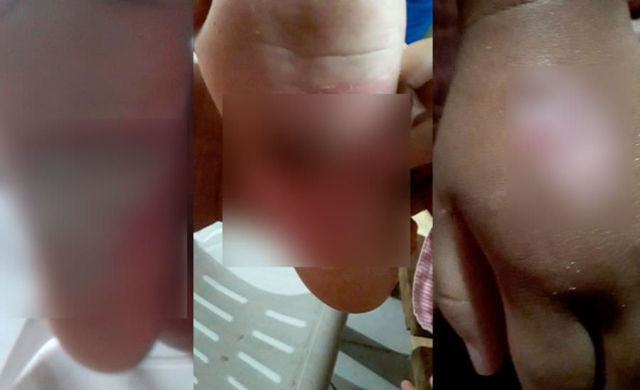 Polícia prende pai por torturar e queimar a filha de 3 anos