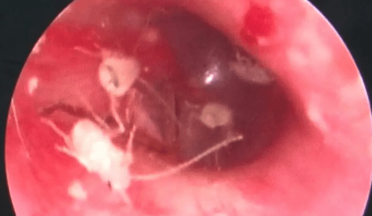 Médicos encontram família de baratas “morando” no ouvido de homem