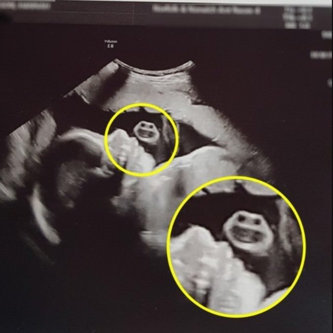 ‘Não é a mamãe:’ mulher toma susto ao ver Baby Sauro em ultrassom do filho