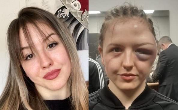 Boxeadora sofre contusão na cabeça e tem rosto desfigurado no ringue 