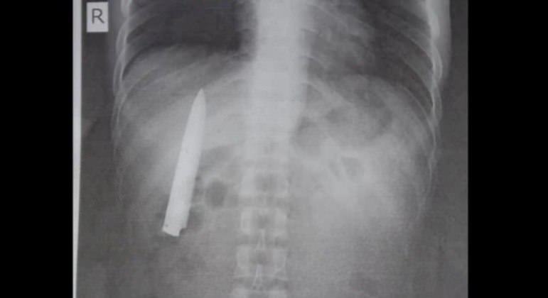 Após exame, jovem descobre lâmina encravada no peito há 14 meses