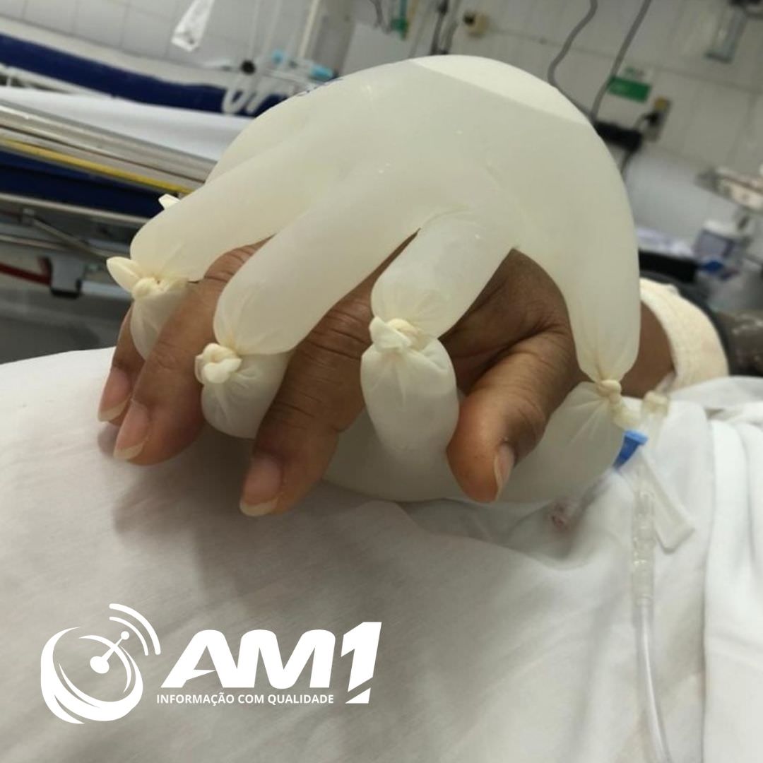 Enfermeiros de SP usam ‘mãozinha do amor’ para amparar pacientes intubados