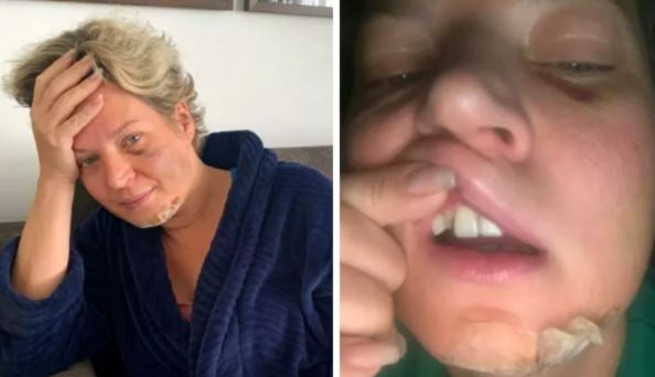 Joice Hasselmann acorda com dentes quebrados, hematomas e diz que sofreu ‘atentado’