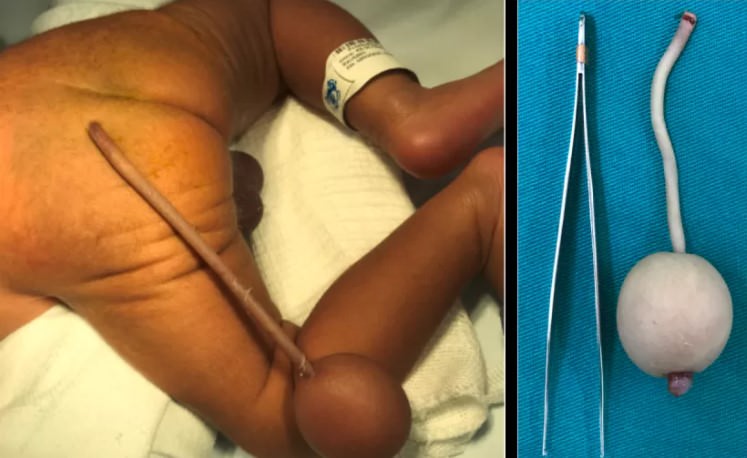 Raridade: bebê nasce com cauda de 12 centímetros em Fortaleza