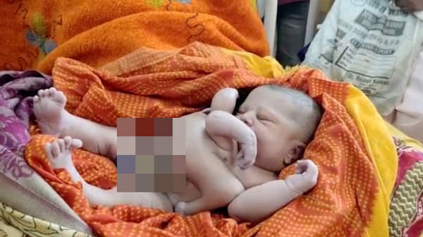 Bebê nasce com quatro braços e quatro pernas na Índia e é tratado como um deus