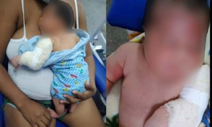 Bebê tem braço fraturado durante parto no interior do AM e família pede ajuda