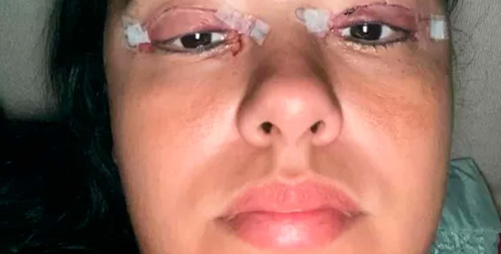 Vídeo: mulher quase perde a visão após ter cílios colados com Super Bonder