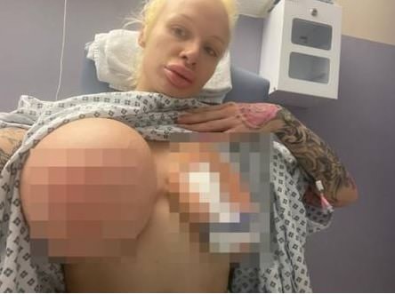 Implante de silicone explode no seio de atriz pornô: ‘a pele inchou e estava toda preta’