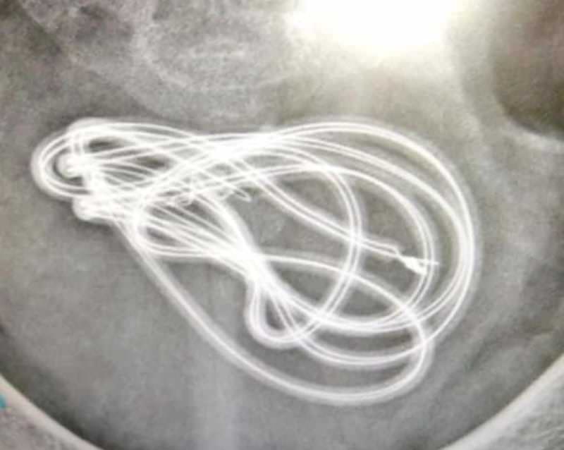 Homem introduz cabo de fone de ouvido de 80 cm em bexiga durante masturbação