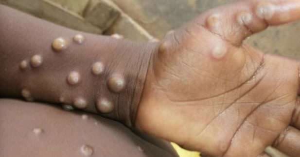 Surto de varíola do macaco registra mais de 100 casos