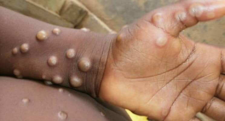 FVS emite alerta de risco e pede atenção preventiva para varíola do macaco no Amazonas