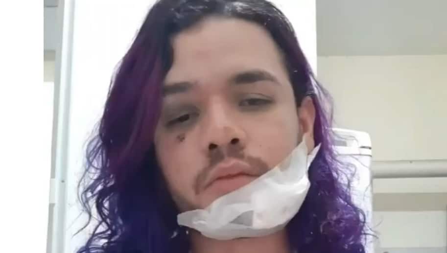 Vídeo: cabeleireiro afirma que estudante de direito arrancou pedaço do seu rosto a dentadas