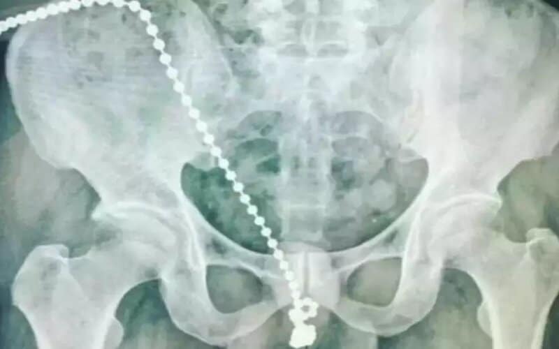 Homem passa por cirurgia no pênis após introduzir corrente de bolinhas