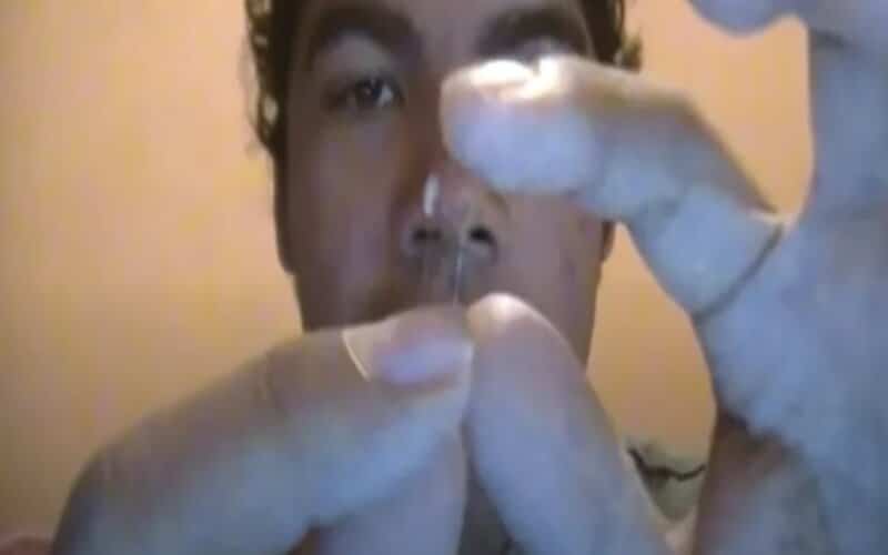 Homem é internado ao operar nariz em casa após ver vídeo na internet