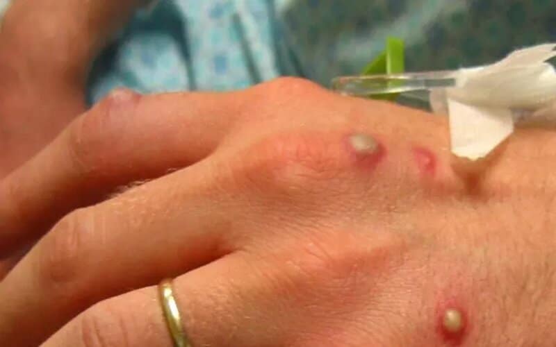 Monkeypox: sobe para 89 número de casos no Amazonas