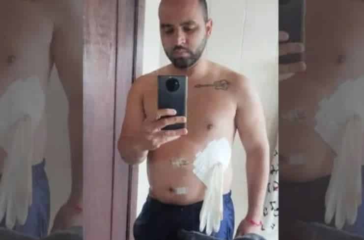 Paciente sai de clínica com luva no lugar de bolsa de colostomia: 'constrangido'