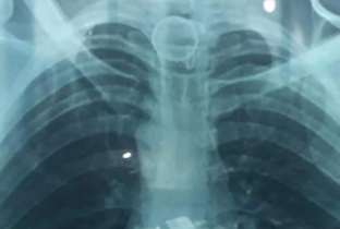 Homem passa por cirurgia após engolir tampa de garrafa no interior do AM