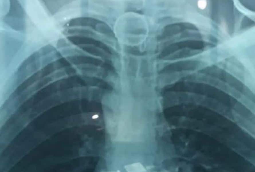 Homem passa por cirurgia após engolir tampa de garrafa no interior do AM