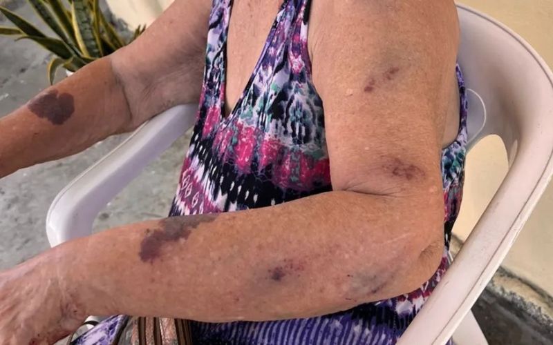 Covardia: idosa de 87 anos é agredida pela neta com cabo de vassoura