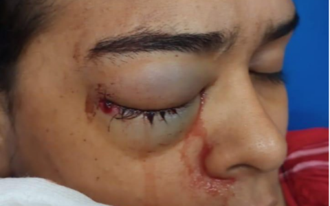 Mulher é atingida no olho por bala de ar comprimido durante arraial em shopping de Manaus