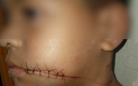 Mãe de criança que teve boca decepada por linha de cerol alerta sobre perigo