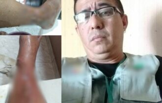 Cinegrafista quase perde a perna durante assalto em Manaus; ele pede ajuda para custear pós-operatório