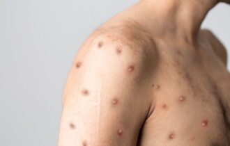 Região Norte do Brasil registra casos de mpox
