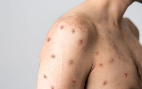 Com 709 casos de mpox no Brasil, ministério convoca reunião