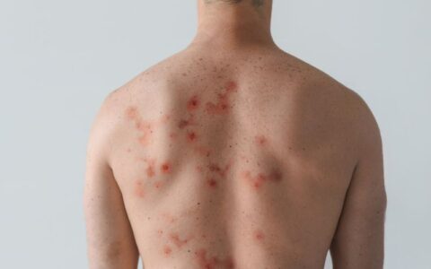 Governo paulista reforça vigilância e monitoramento da mpox no estado
