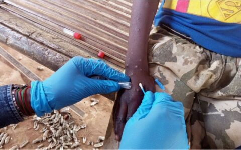 Mpox: OMS pede resposta após registro de nova variante na Suécia
