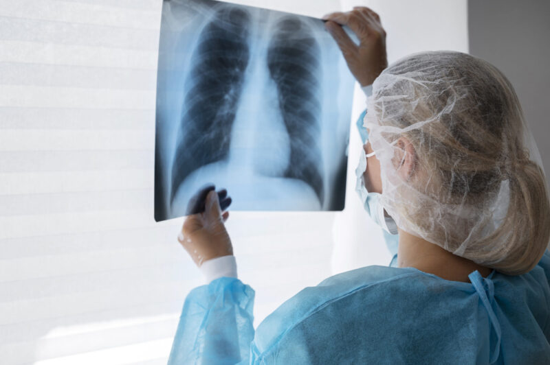 cancer-de-pulmao-diagnostico-t